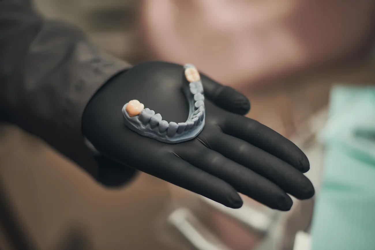 Modelo odontológico com coroas para o planejamento restaurador.